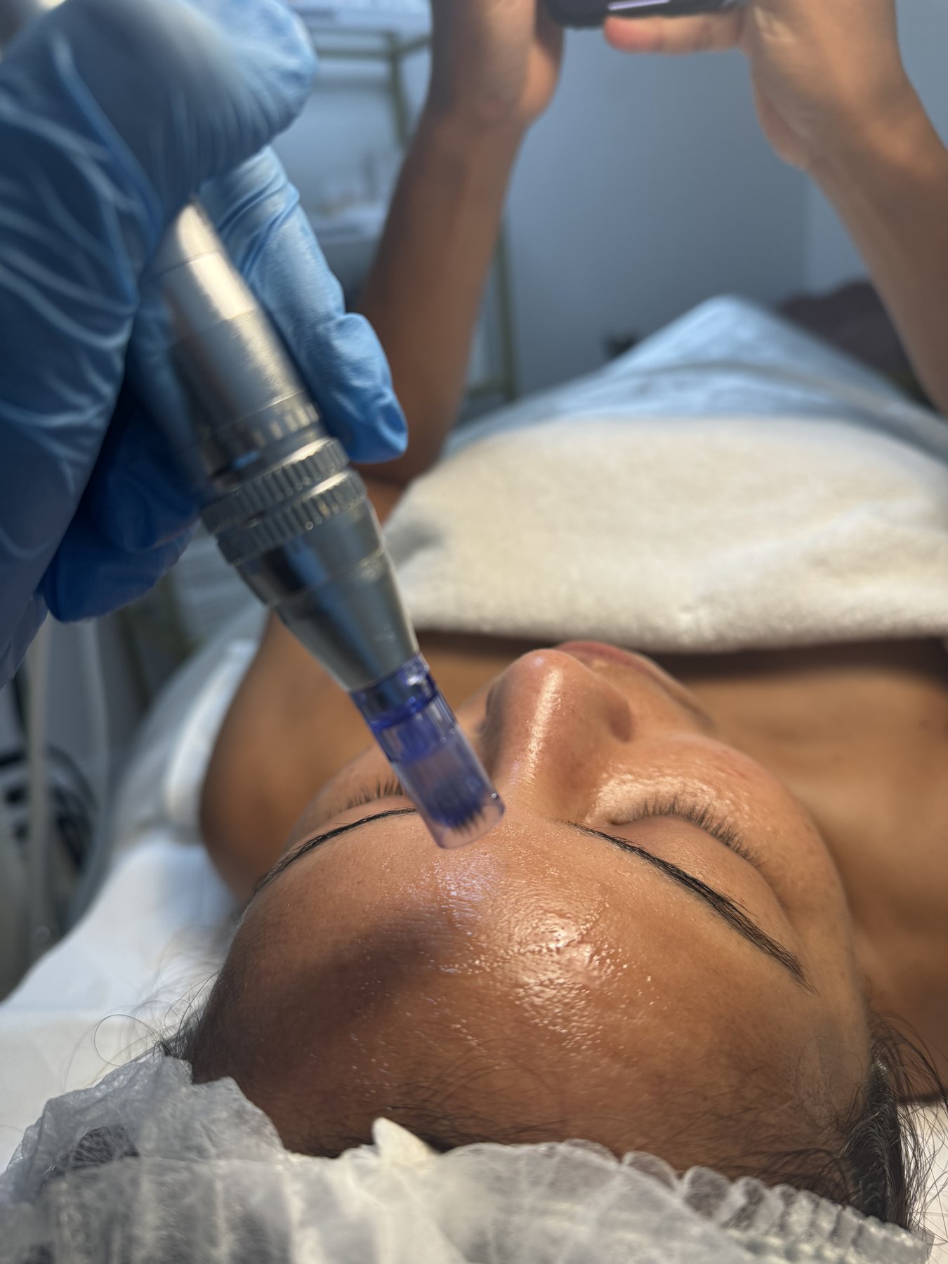 BT Signature Microneedling Glow